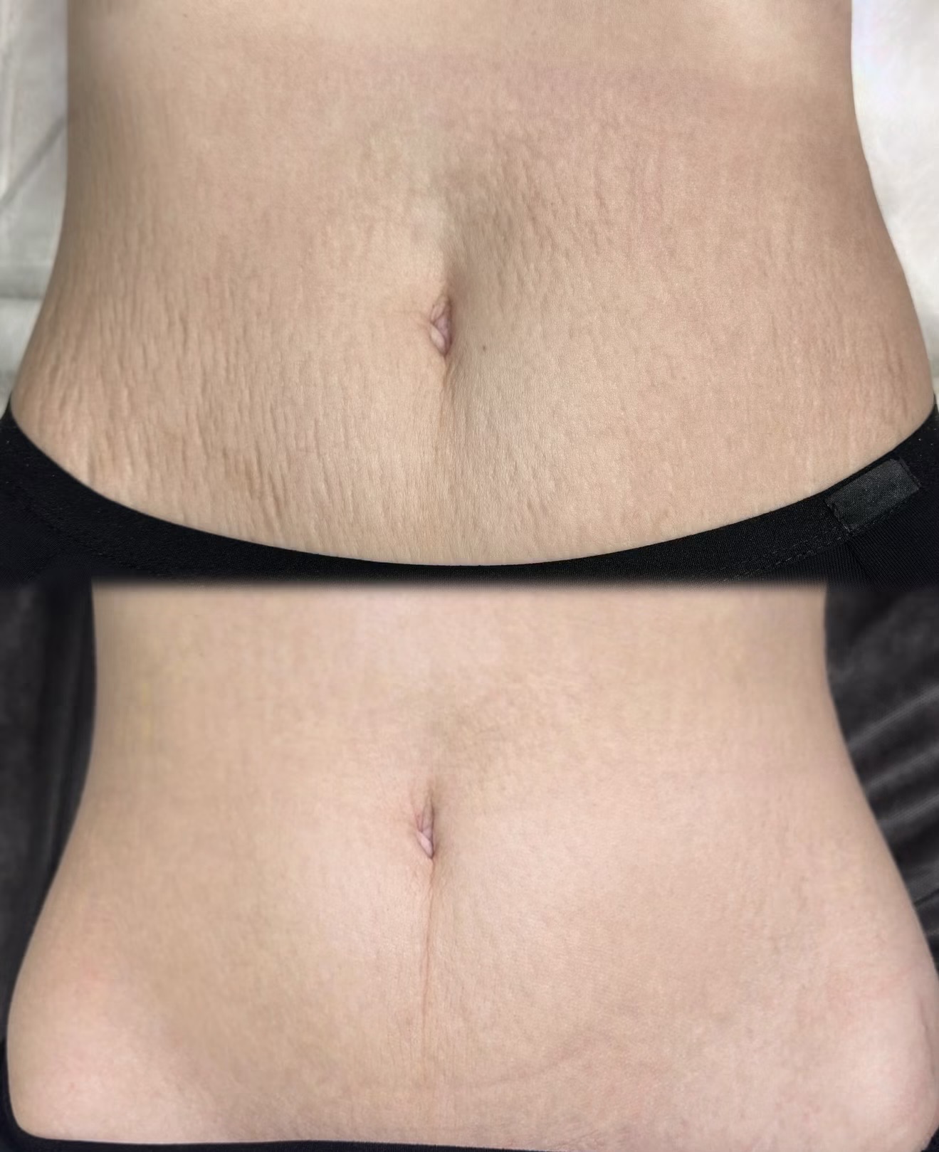 Abdominal stretch mark comparison