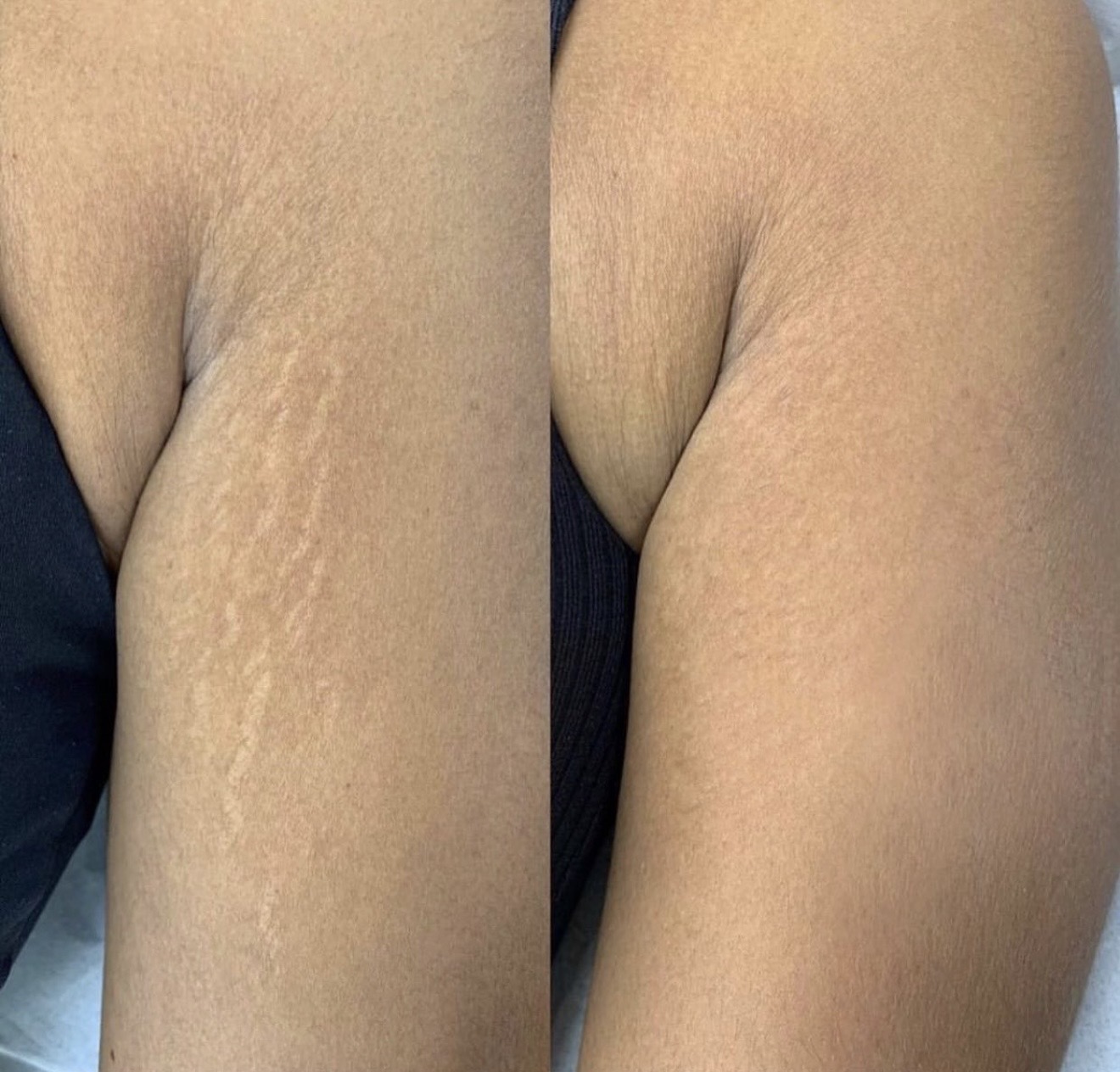 Upper arm stretch mark comparison